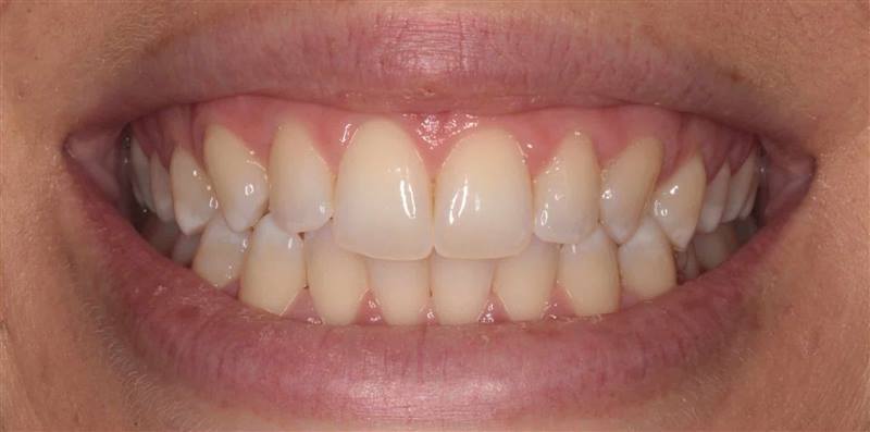 Teeth Whitening Before